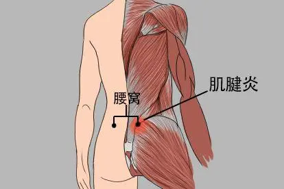 腰窝中间肌腱炎图片