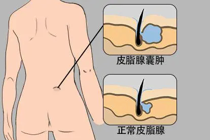 腰窝中间皮脂腺囊肿图片