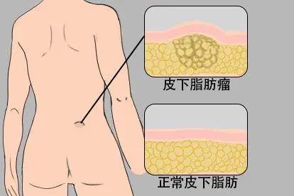 腰窝中间皮下脂肪瘤图片