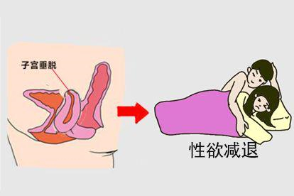 性欲减退图