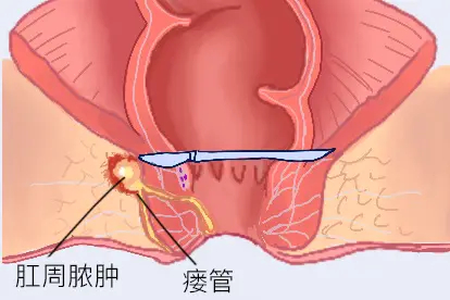 瘘疮手术治疗方法图片