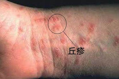 疥疮皮疹图片