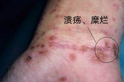 疥疮皮肤溃疡图片