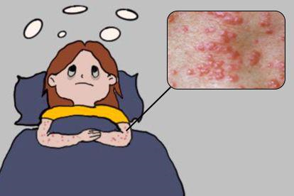 疥疮睡眠障碍图片