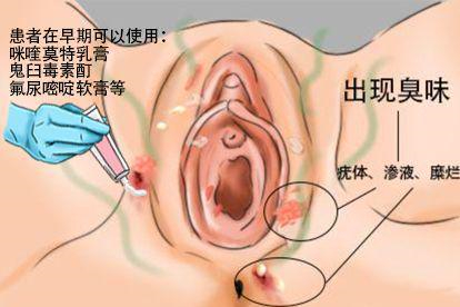 女性轻微湿疣药物治疗图