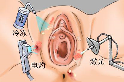 女性轻微湿疣物理治疗图