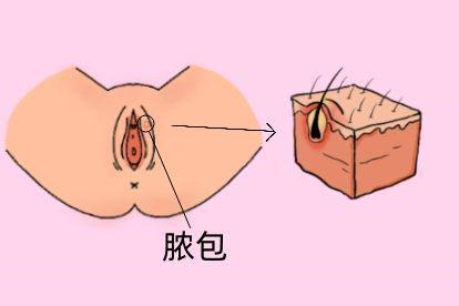 外阴道口毛囊炎脓包图片
