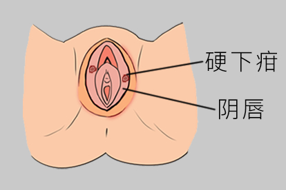 女性梅毒初期硬下疳图片