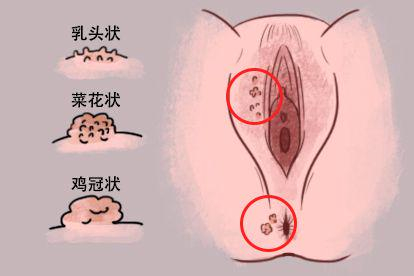 小阴唇内侧长了个瘊子图片