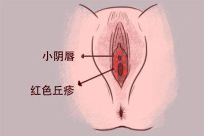 外阴感染图片
