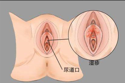 湿疹图片