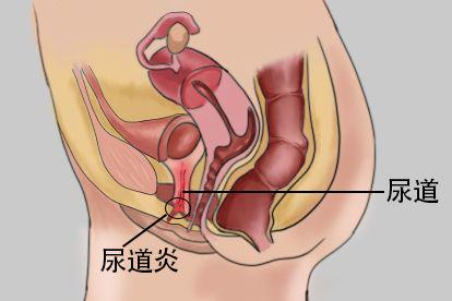 尿道炎图片