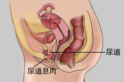 尿道息肉图片