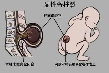 婴儿显性脊柱裂图片