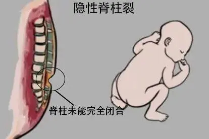 婴儿隐性脊柱裂图片