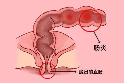 肠炎图片