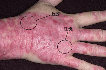 银屑病红斑图片