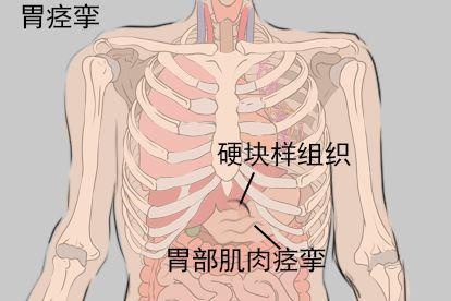 胃痉挛图片