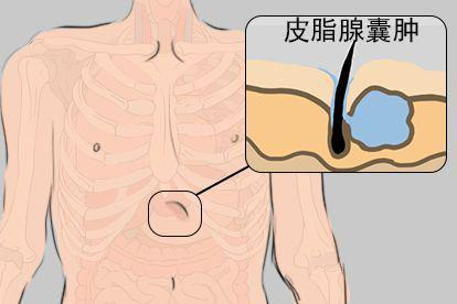 皮脂腺囊肿图片