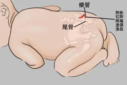 尾骨处瘘管图片