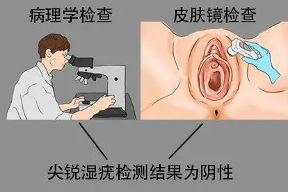 尖锐湿疣检测结果为阴性图