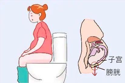 膀胱下垂图片