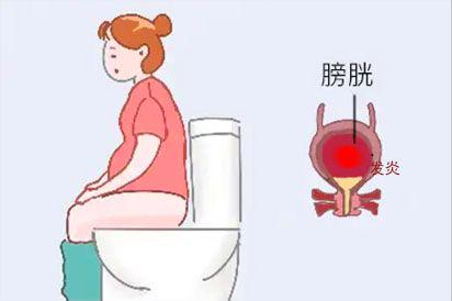膀胱炎图片