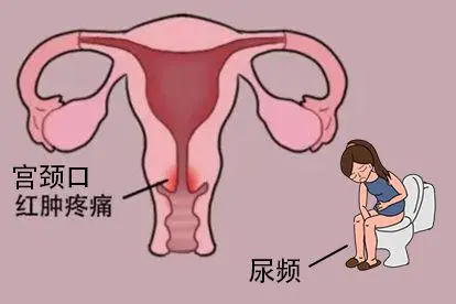 女性淋病红肿图片