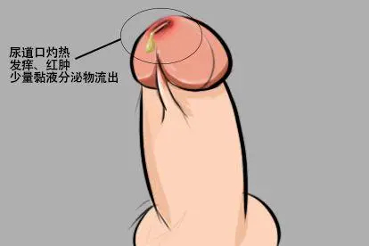 男性淋病红肿图片