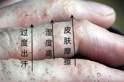 汗疱疹病因图