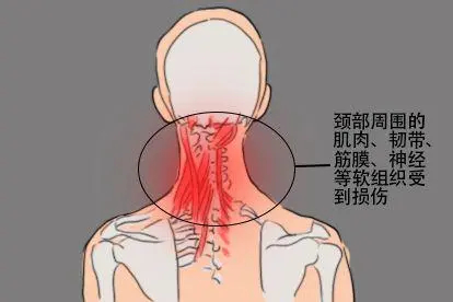 落枕脖子内部图片