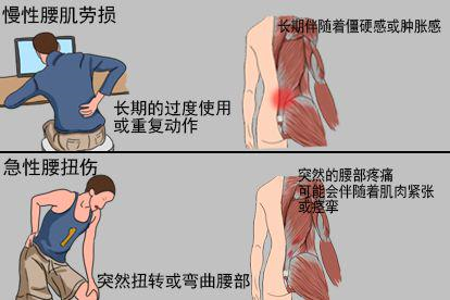 慢性腰肌劳损和急性腰扭伤不同点