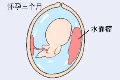 孕3月水囊瘤胎儿图片