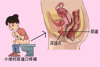 尿道炎图片
