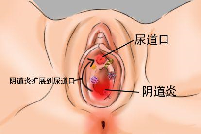 阴道炎图片