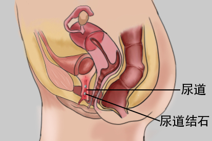 尿道结石图片