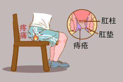 肛门疼痛图片