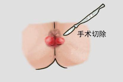 手术切除图片