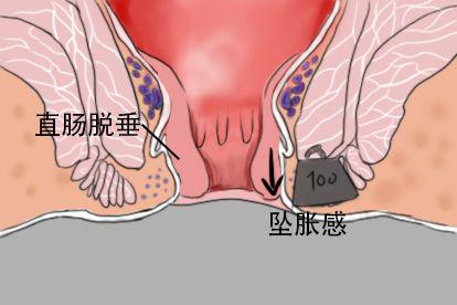 肛门坠胀感图片