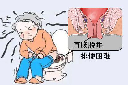 排便困难图片