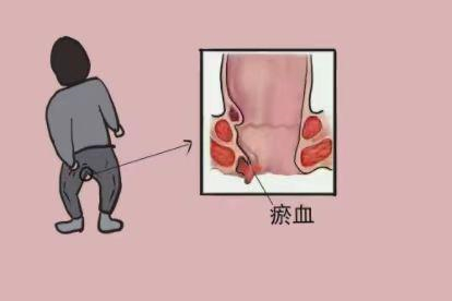 血栓性外痔图片