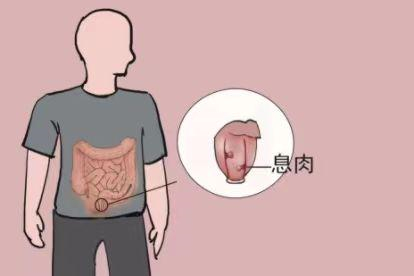 直肠息肉图片