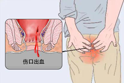 痔疮吻合器钛钉脱落症状图