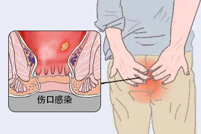 痔疮吻合器钛钉脱落症状图