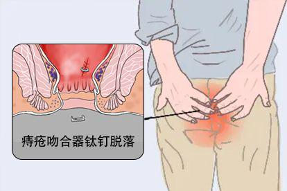 痔疮吻合器钛钉脱落症状图