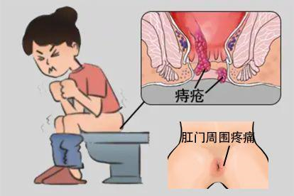 肛门疼痛图片