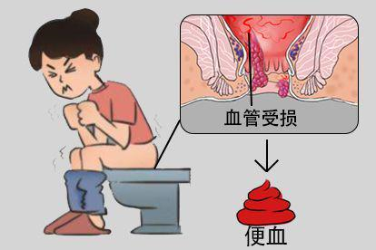 便血图片