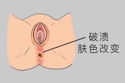 肛周湿疹图