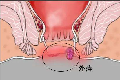 外痔图片