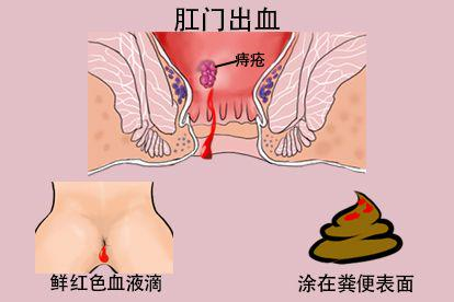 肛门出血图